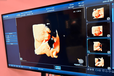 Imbasan 5D wajah bayi dalam kandungan